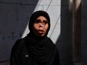 Read more about the article In Gaza, a long path to recovery for one woman who lost eye, and daughter